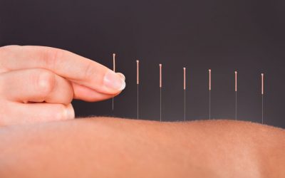 Beneficios de la Acupuntura